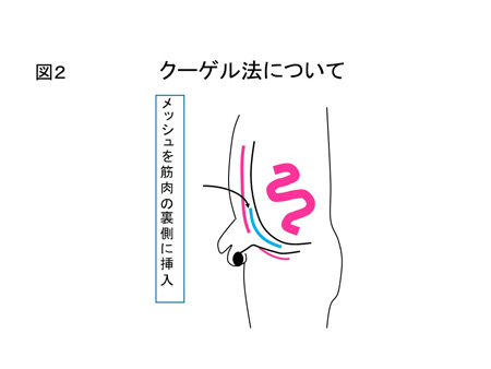 腹膜前到達法（図２）