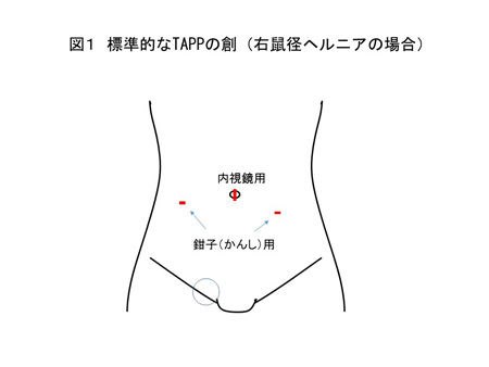 TAPP（図１）